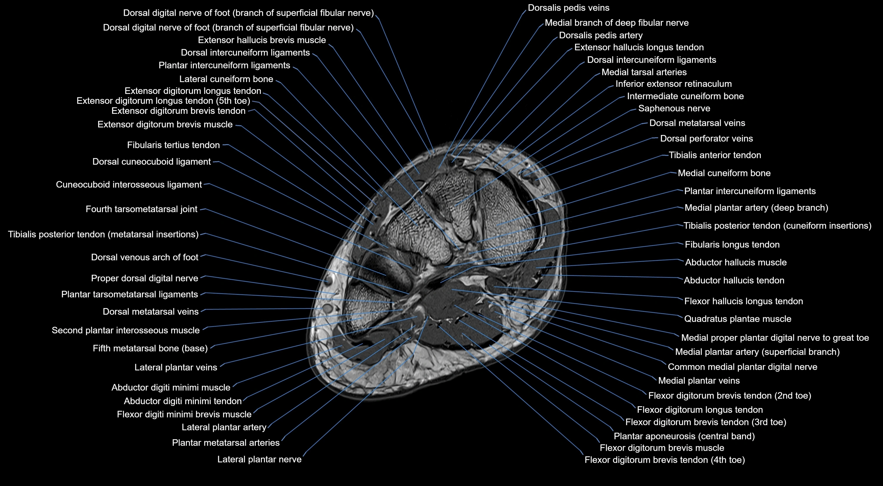 MRI mid foot coronal ligaments cross sectional anatomy 3T  radiology  image-img-00001-00021.webp